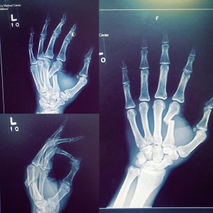 fractura Daniel Straus Bellator 145