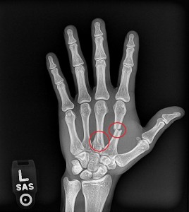 fractura Bruno Escalante