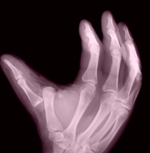 Fractura Roy Nelson UFC Fight Night 75