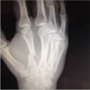 fractura Ryan Bader UFC Fight Night 33