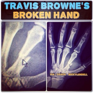 fractura Travis Browne UFC on Fox 11